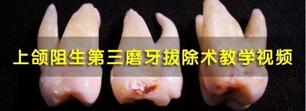 口腔冲洗液怎么喷牙科临床根管冲洗液次氯酸钠使用心得_https://www.jmylbn.com_新闻资讯_第9张