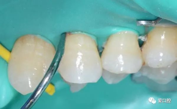 楔状缺损充填时小技巧的应用