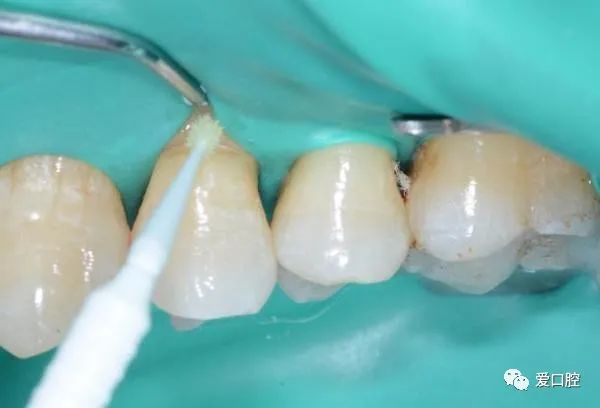 楔状缺损充填时小技巧的应用