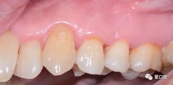 楔状缺损充填时小技巧的应用