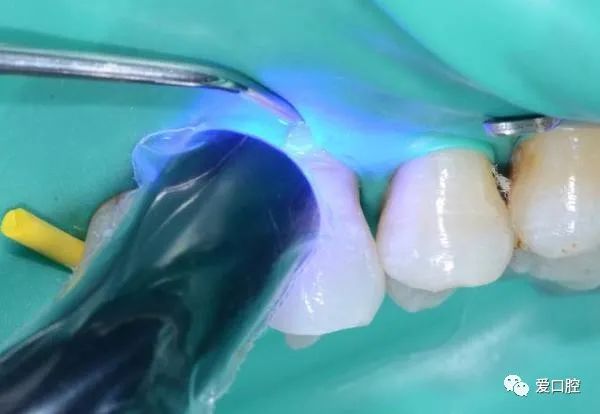 楔状缺损充填时小技巧的应用