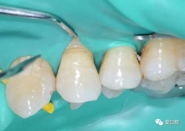 楔状缺损充填时小技巧的应用