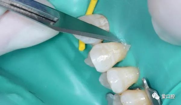 楔状缺损充填时小技巧的应用