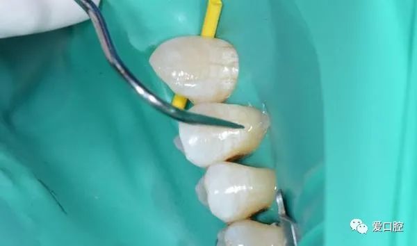 楔状缺损充填时小技巧的应用