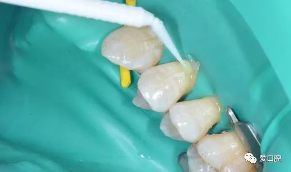 楔状缺损充填时小技巧的应用