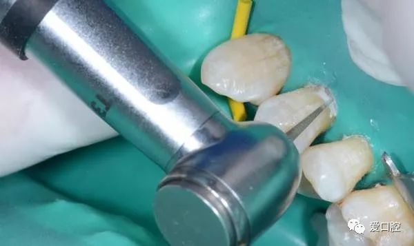 楔状缺损充填时小技巧的应用