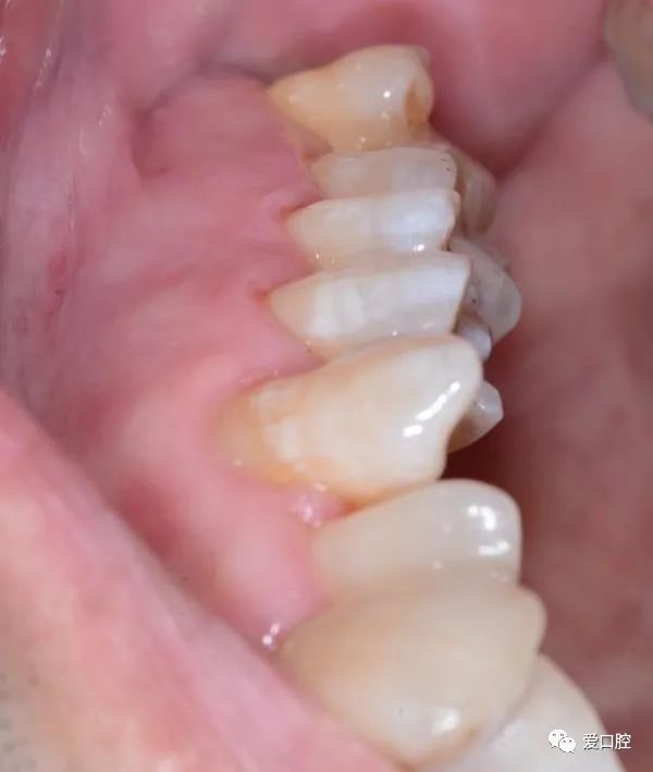 楔状缺损充填时小技巧的应用