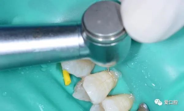 楔状缺损充填时小技巧的应用