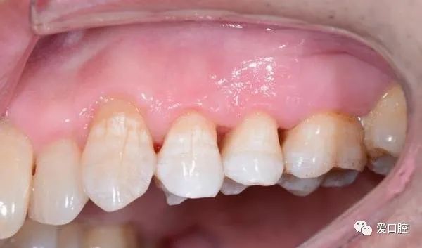 楔状缺损充填时小技巧的应用