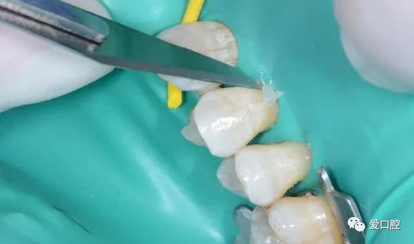 楔状缺损充填时小技巧的应用