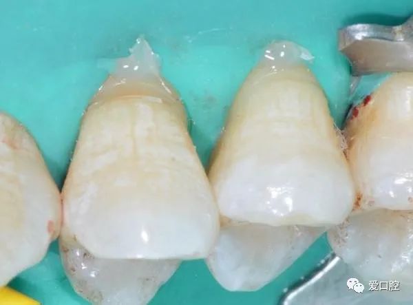 楔状缺损充填时小技巧的应用