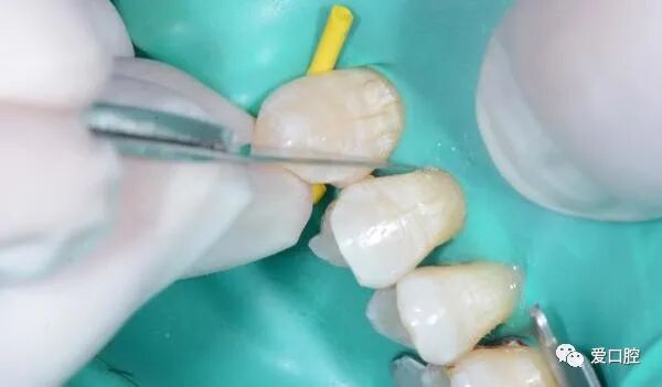 楔状缺损充填时小技巧的应用