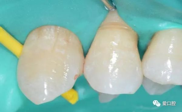 楔状缺损充填时小技巧的应用