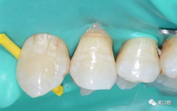 楔状缺损充填时小技巧的应用