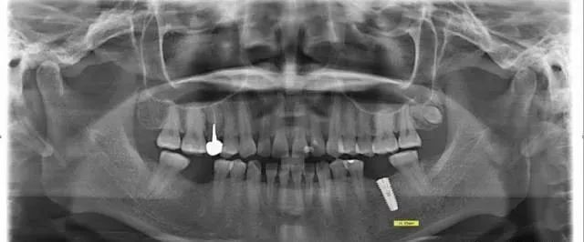 警惕全景片的放大率