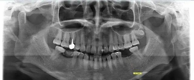 警惕全景片的放大率