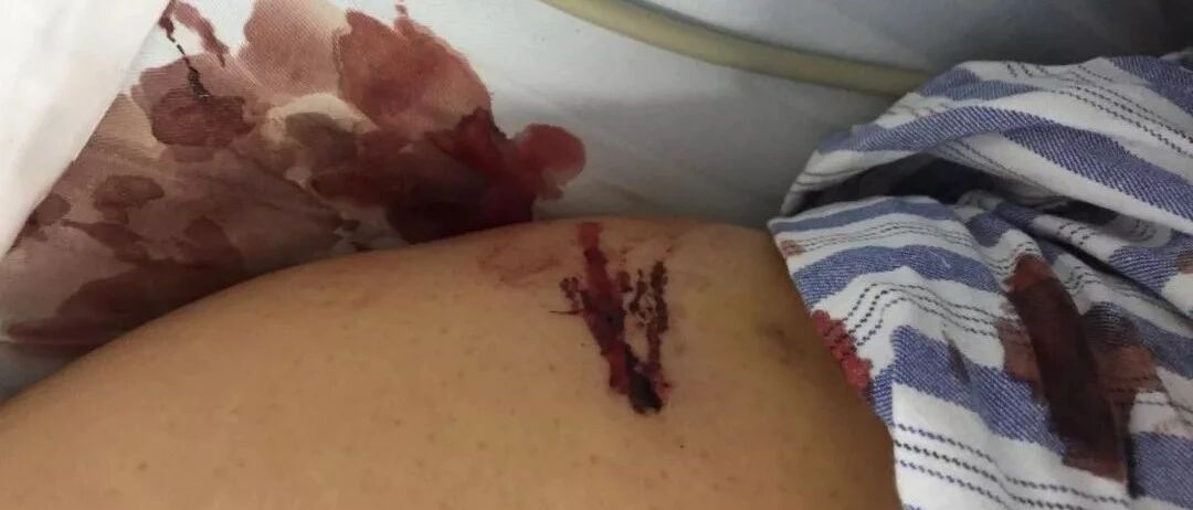 低分子肝素钙皮下注射，不注意“针”的会出问题！