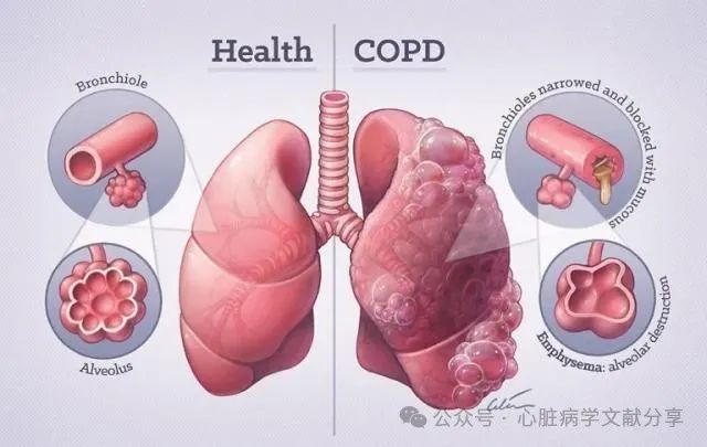 什么是气体陷闭慢性阻塞性肺疾病诊治指南_https://www.jmylbn.com_新闻资讯_第1张
