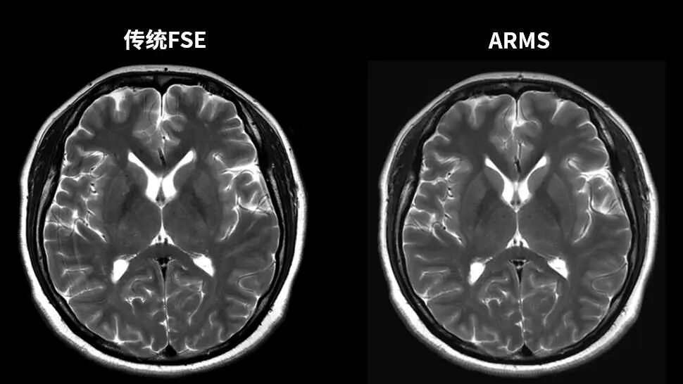 联影磁共振怎么样更先进、更高效、更精准—联影3.0T超导磁共振落户武城县人民医院_https://www.jmylbn.com_新闻资讯_第13张