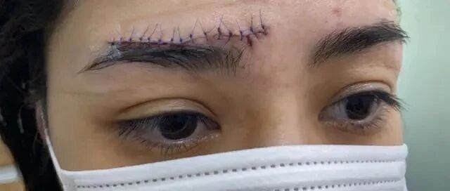 阿娇额头被撞后首晒高清伤口照，皮肤布满针孔看后令人头皮发麻