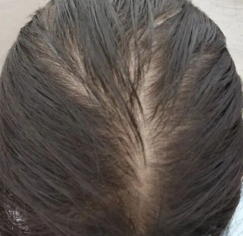 【郑州皮肤科毛囊检测】什么是脂溢性脱发？快来辨别你是否属于脂溢性脱发？郑州脱发治疗医院