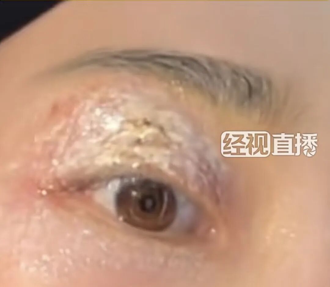 “会飞的硫酸”将进入活跃期，有人中招脖子烂了一圈