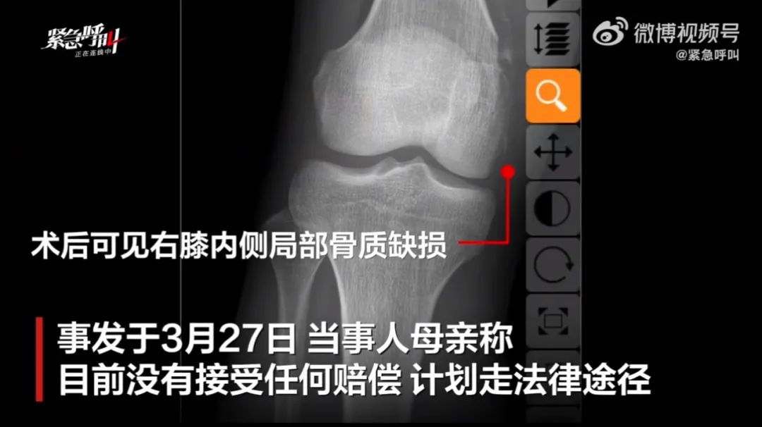 错切右膝医生被撤职