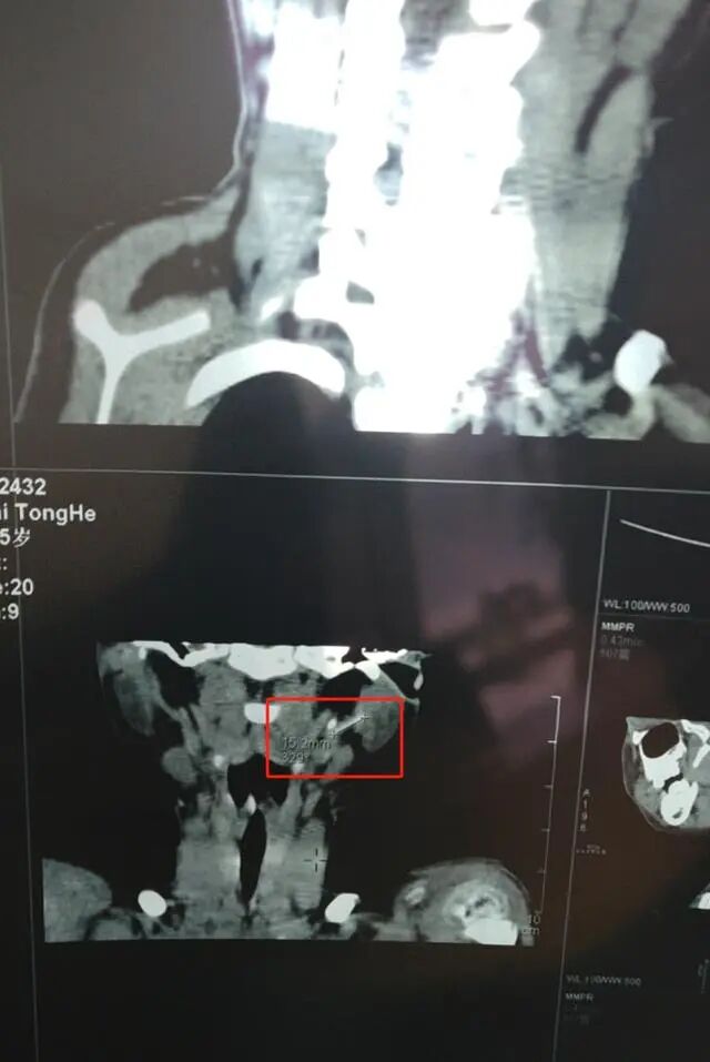 留置针怎么取出男婴输液时针头导管留体内5年，最近进展：已取出_https://www.jmylbn.com_新闻资讯_第9张