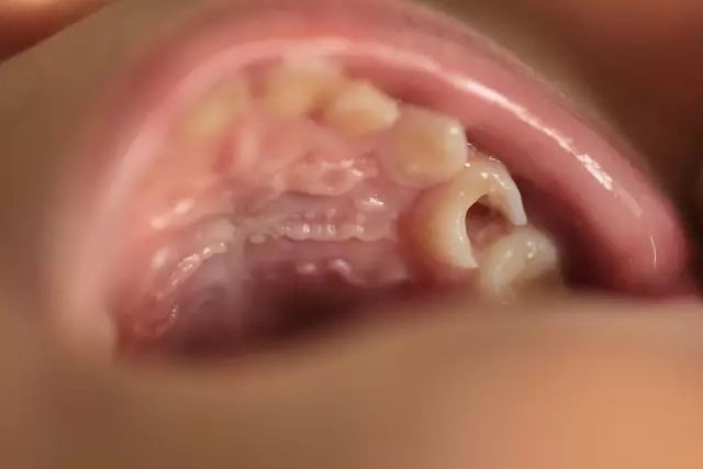 拔烂牙根有危险吗_烂牙根一般几年内必须拔_拔掉烂牙根多久才能补牙