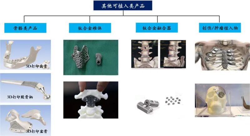 【科技前沿】3D打印钛合金人体骨骼，原来“换骨”术早就有了的图1