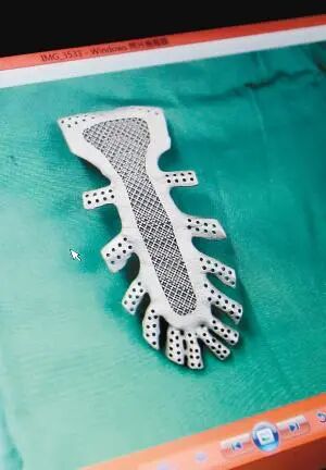 【科技前沿】3D打印钛合金人体骨骼，原来“换骨”术早就有了的图2