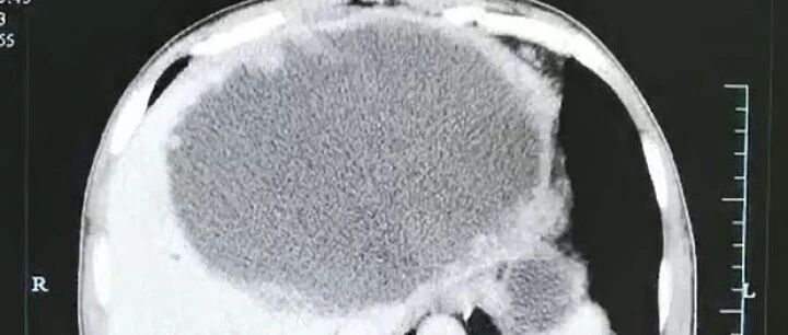 男子左肝被掏空，壁上布满虫卵！罪魁祸首竟是这种食物，很多广东人都爱吃……