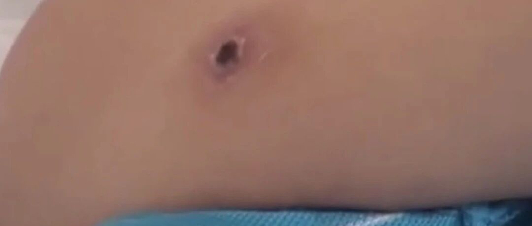 发热一周，女子多次核酸检测后，发现罪魁祸首又是它…...夏季高发多人中招！