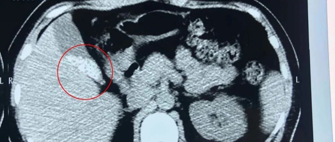 女子常年吃素，备孕体检时大惊：体内长出100颗“黑宝石”！千万不要这样吃