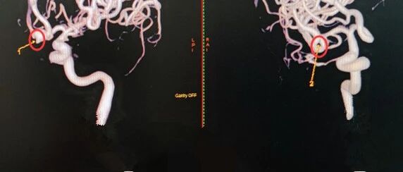 广东一女子突然头痛剧烈，脑内竟有7个“不定时炸弹”！医生：冬季尤需注意……