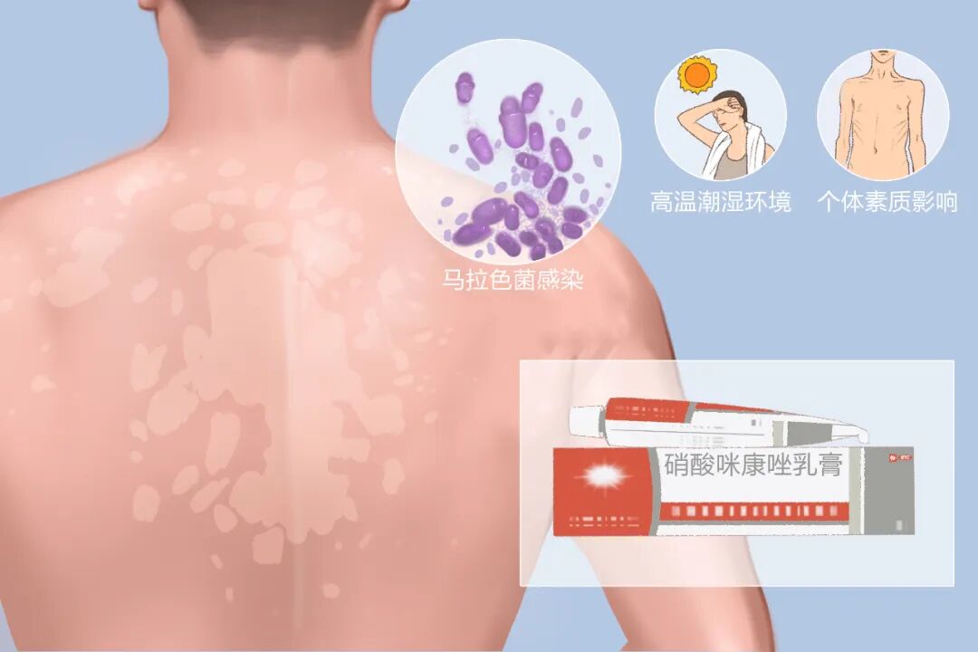 花斑癣是什么原因引起的？花斑糠疹怎么治才能彻底好？