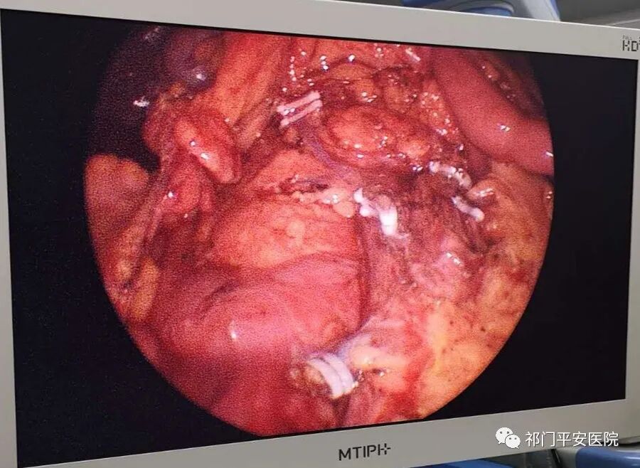 他的结肠癌手术恢复得怎么这么快！