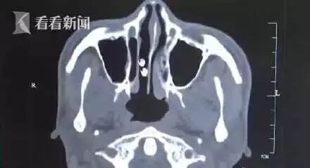 男子鼻甲薄如纸导致大出血 竟与他从事15年的行业有关