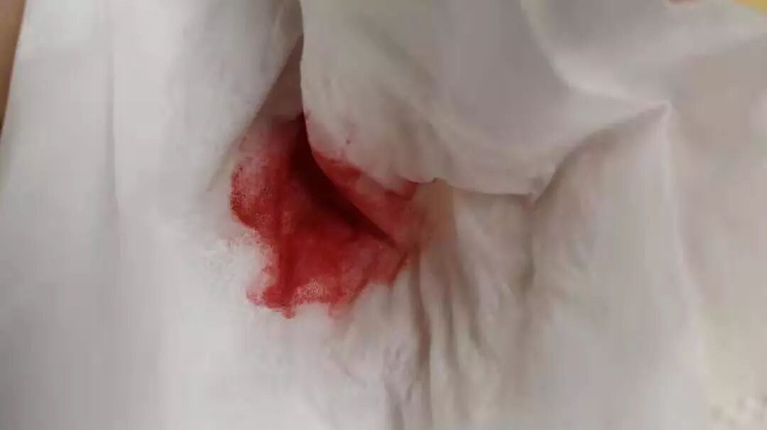 温馨提醒：鼻炎伴随这种鼻出血，要警惕早期鼻咽癌！