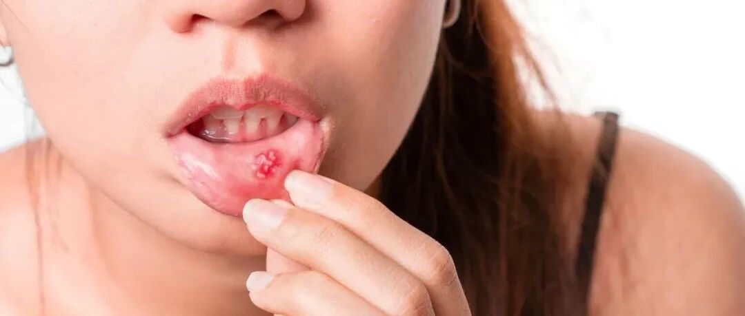 得了口腔溃疡怎么办？推荐几个小妙招