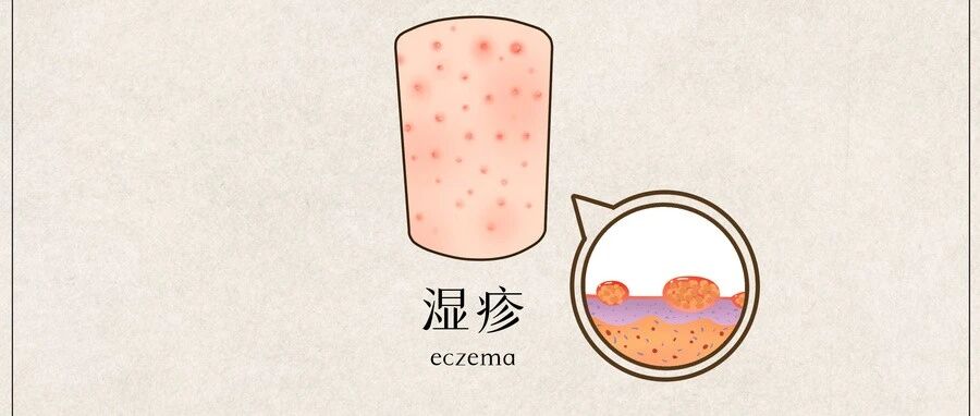 不瞒您说，这湿疹还真有假冒的！