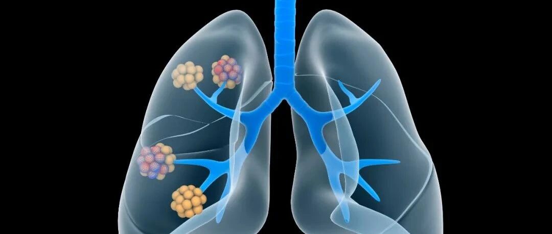 查出肺部磨玻璃结节，要不要手术？