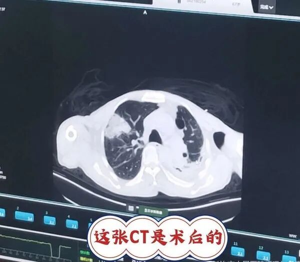 氦氩刀是什么氩氦刀冷冻消融术——延续生命的法宝_https://www.jmylbn.com_新闻资讯_第7张