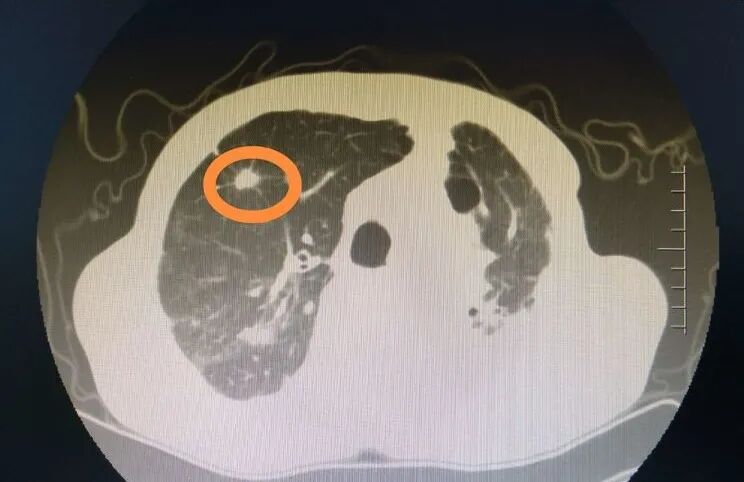 氦氩刀是什么氩氦刀冷冻消融术——延续生命的法宝_https://www.jmylbn.com_新闻资讯_第2张