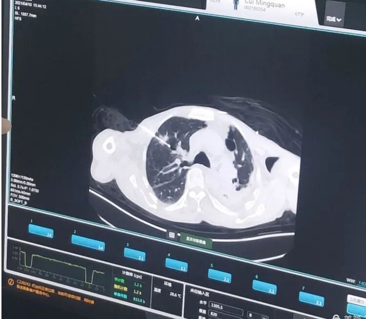 氦氩刀是什么氩氦刀冷冻消融术——延续生命的法宝_https://www.jmylbn.com_新闻资讯_第6张