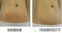 多极射频是什么多级射频治疗妊娠纹，产后妈妈的美丽新武器_https://www.jmylbn.com_新闻资讯_第6张