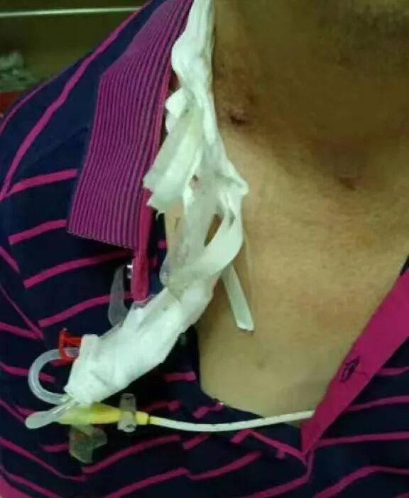 中心导管怎么使用医护解读｜透析用中心静脉导管的注意事项_https://www.jmylbn.com_新闻资讯_第5张