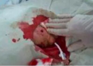 中心导管怎么使用医护解读｜透析用中心静脉导管的注意事项_https://www.jmylbn.com_新闻资讯_第7张