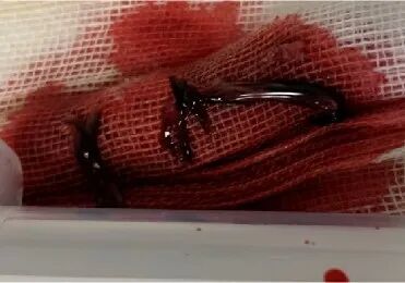 中心导管怎么使用医护解读｜透析用中心静脉导管的注意事项_https://www.jmylbn.com_新闻资讯_第6张