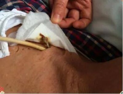 中心导管怎么使用医护解读｜透析用中心静脉导管的注意事项_https://www.jmylbn.com_新闻资讯_第4张